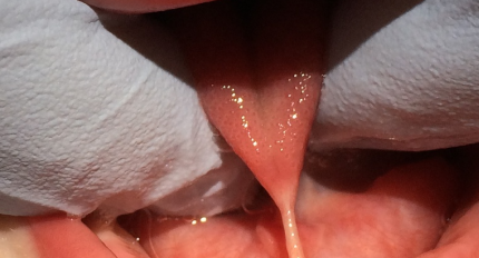 Laser dental procedure